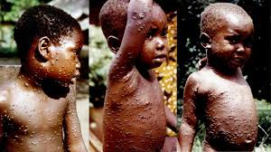 Monkeypox spreads in Nigeria
